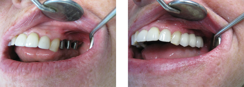Implant Abutments and Implant Retained Crowns - Before and After Images.
