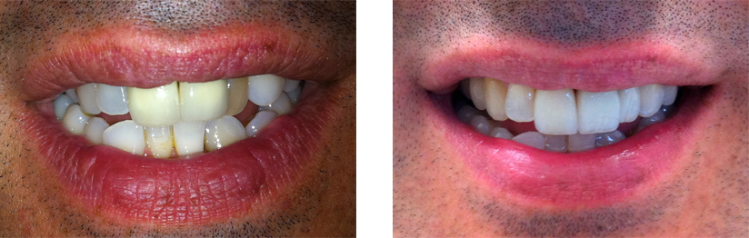 Old Crowns Replaced with All Porcelain Crowns - Before and After Images.